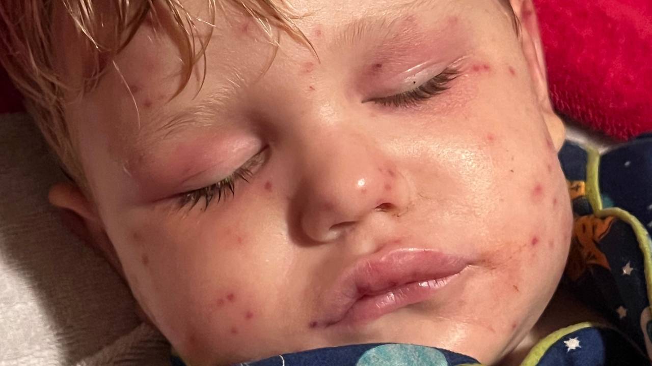 Beckham Reed (2) ist gezeichnet von den vielen Wespenstichen.