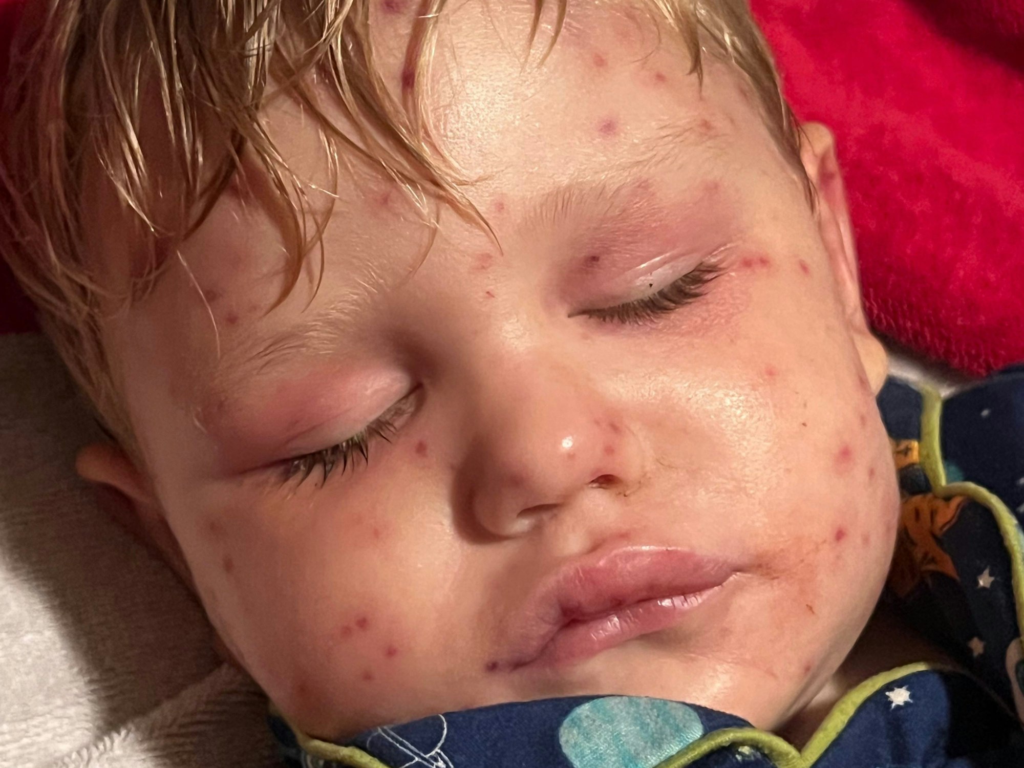 Beckham Reed (2) ist gezeichnet von den vielen Wespenstichen.