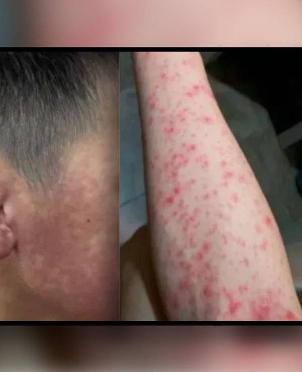 Die Angst vor einer neuen Pandemie ist gestiegen, da China mit dem größten Ausbruch des Chikungunya-Virus in seiner Geschichte zu kämpfen hat. Bilder der Lokalregierung in Foshan zeigen die dramatischen Auswirkungen des Virus.