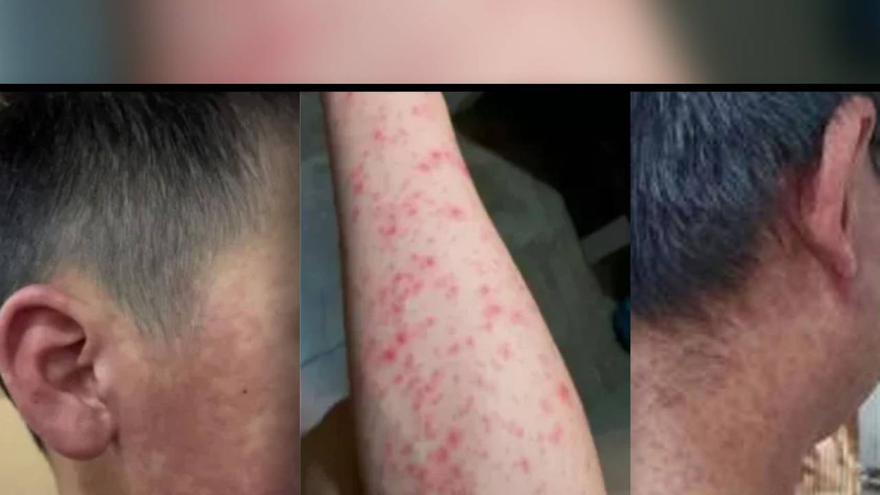 Die Angst vor einer neuen Pandemie ist gestiegen, da China mit dem größten Ausbruch des Chikungunya-Virus in seiner Geschichte zu kämpfen hat. Bilder der Lokalregierung in Foshan zeigen die dramatischen Auswirkungen des Virus.