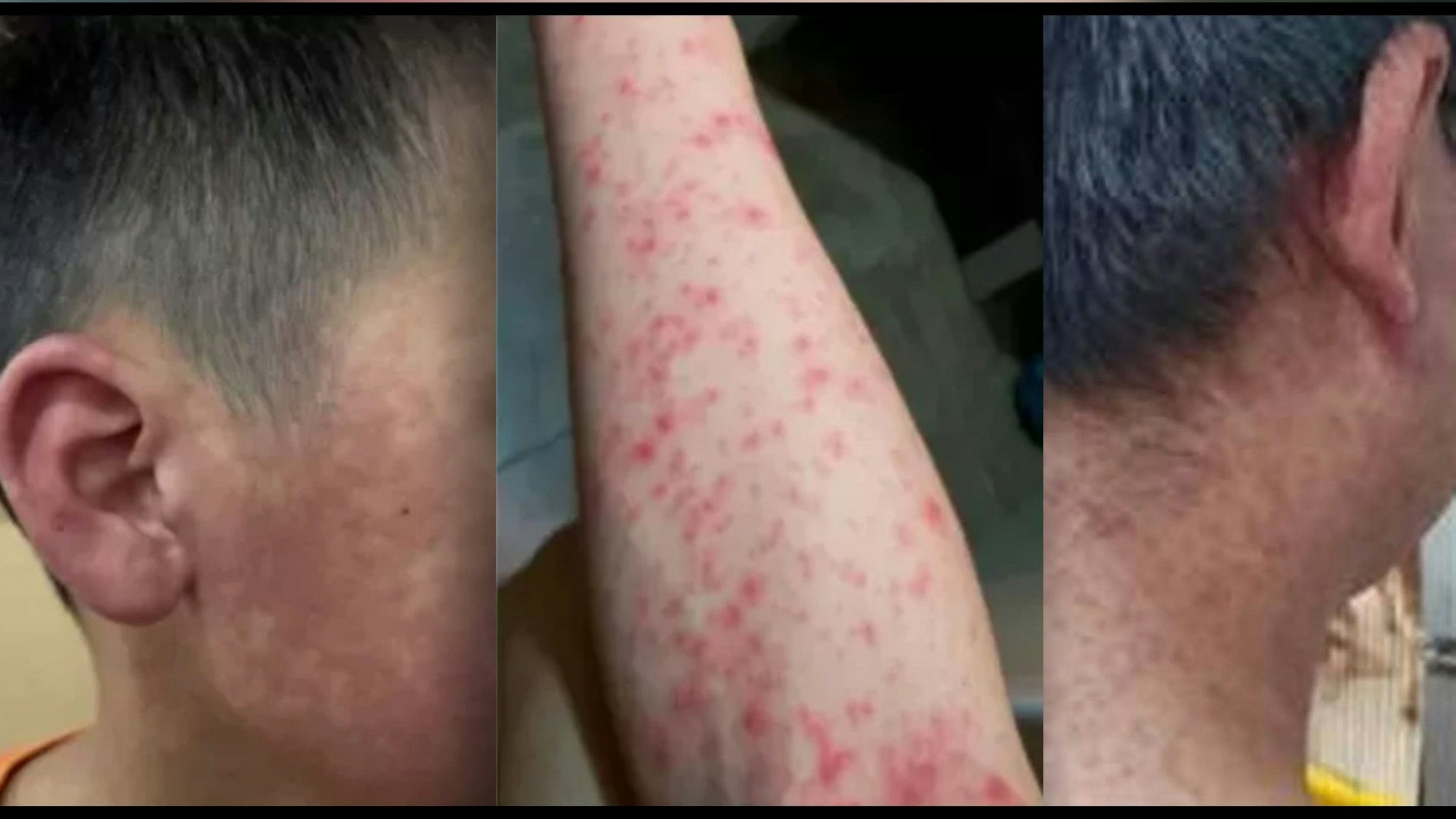 Die Angst vor einer neuen Pandemie ist gestiegen, da China mit dem größten Ausbruch des Chikungunya-Virus in seiner Geschichte zu kämpfen hat. Bilder der Lokalregierung in Foshan zeigen die dramatischen Auswirkungen des Virus.