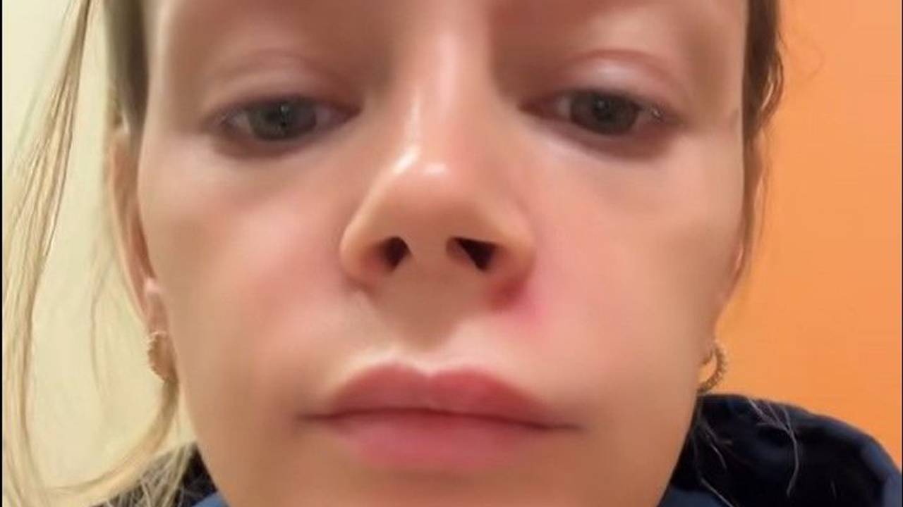 Lisha Marie landete in der Notaufnahme, weil sie einen Pickel ausdrückte.