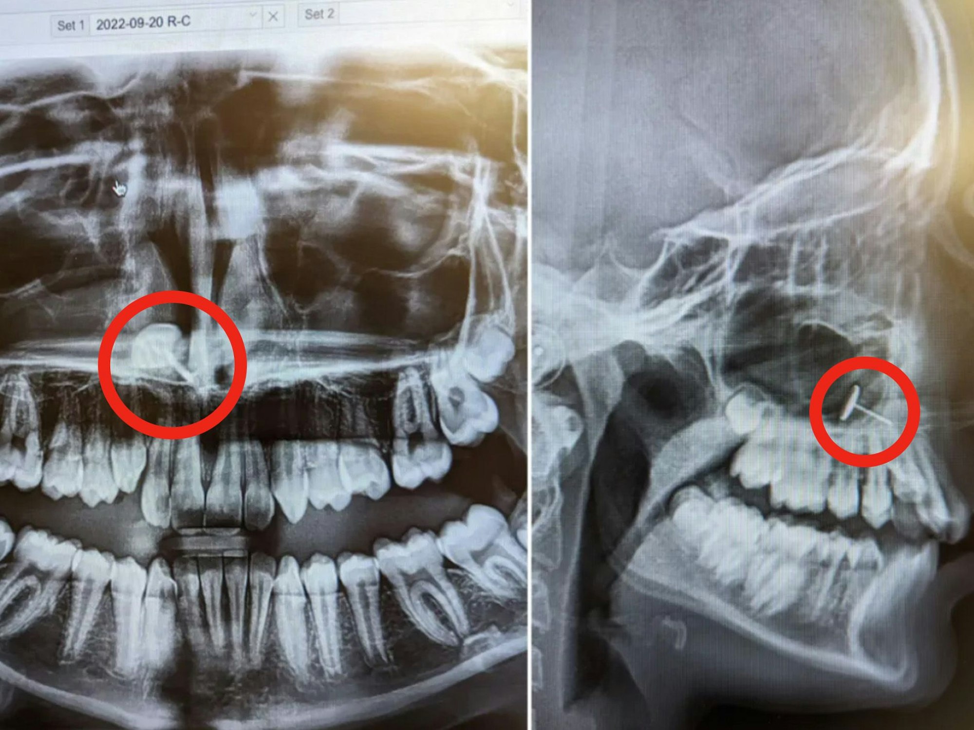 Das Röntgenbild offenbart das ungewöhnliche Metallstück im Rachenraum: Im Kreis ist der Ohrring zu sehen, den sich die Tochter selbst durch die Haut piercen wollte.