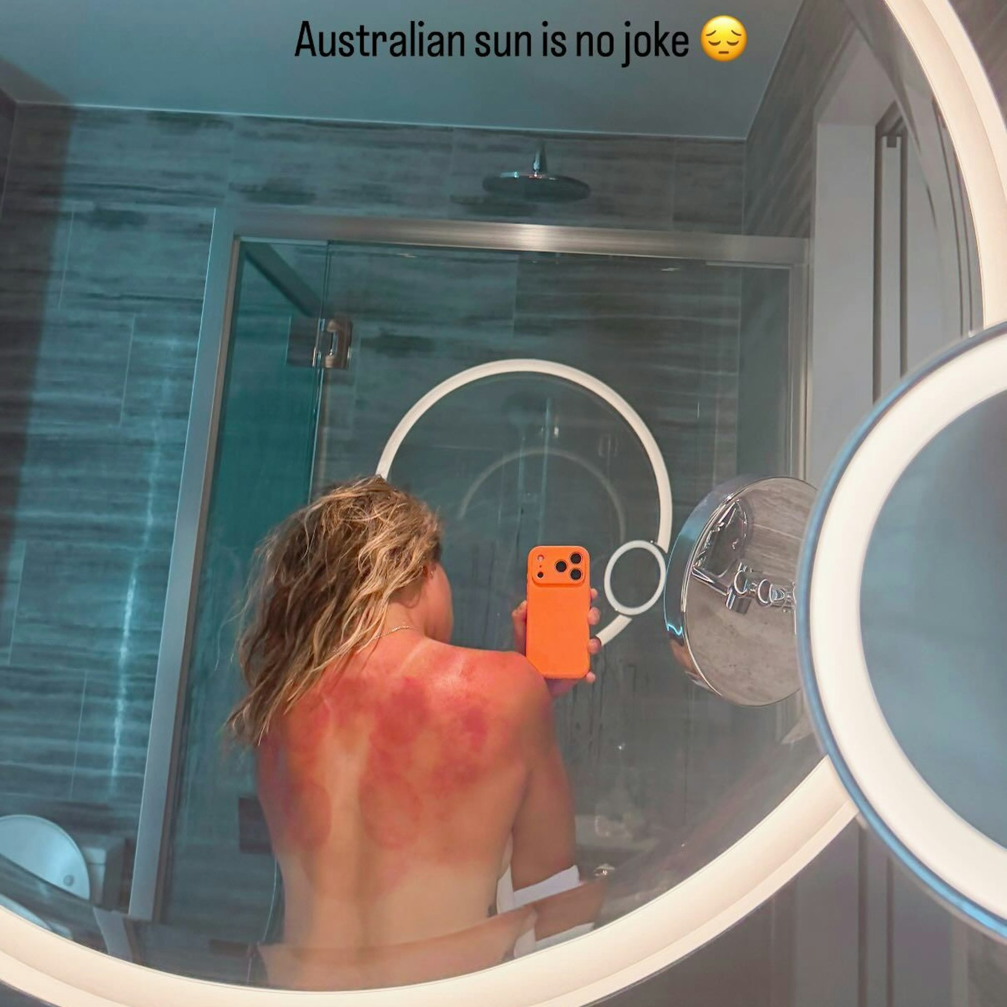 Renata Zarazua zeigt per Spiegel-Selfie ihren verbrannten Rücken.