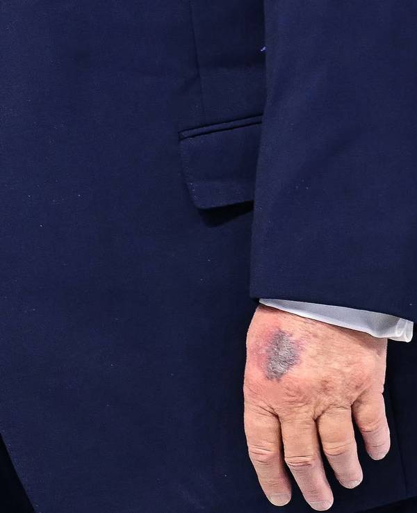 Auf der linken Hand von US-Präsident Donald Trump ist in Davos deutlich ein Bluterguss zu sehen.