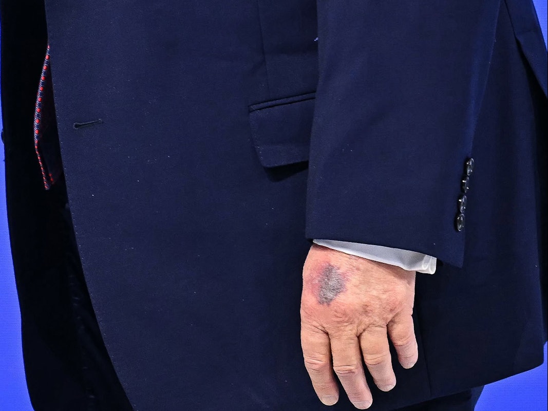 Auf der linken Hand von US-Präsident Donald Trump ist in Davos deutlich ein Bluterguss zu sehen.