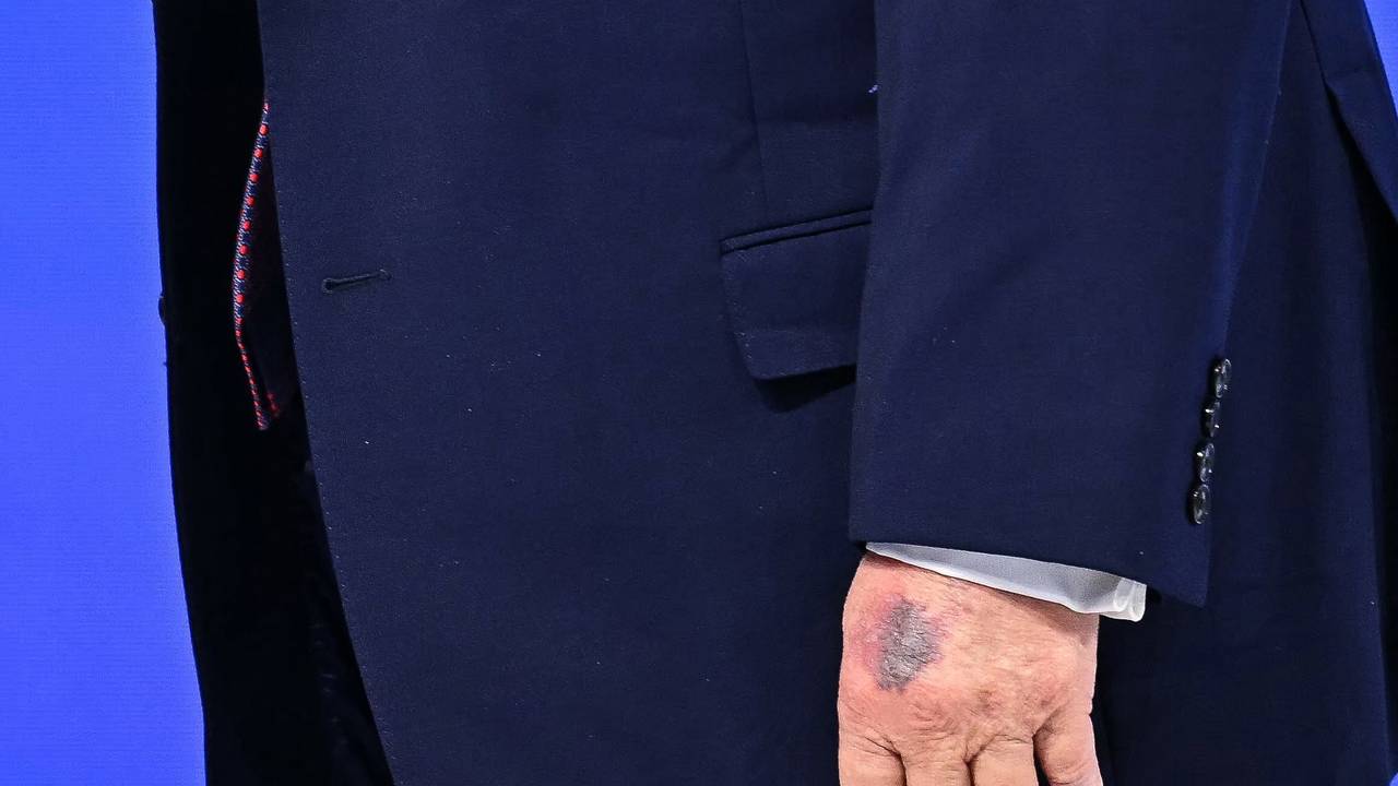 Auf der linken Hand von US-Präsident Donald Trump ist in Davos deutlich ein Bluterguss zu sehen.