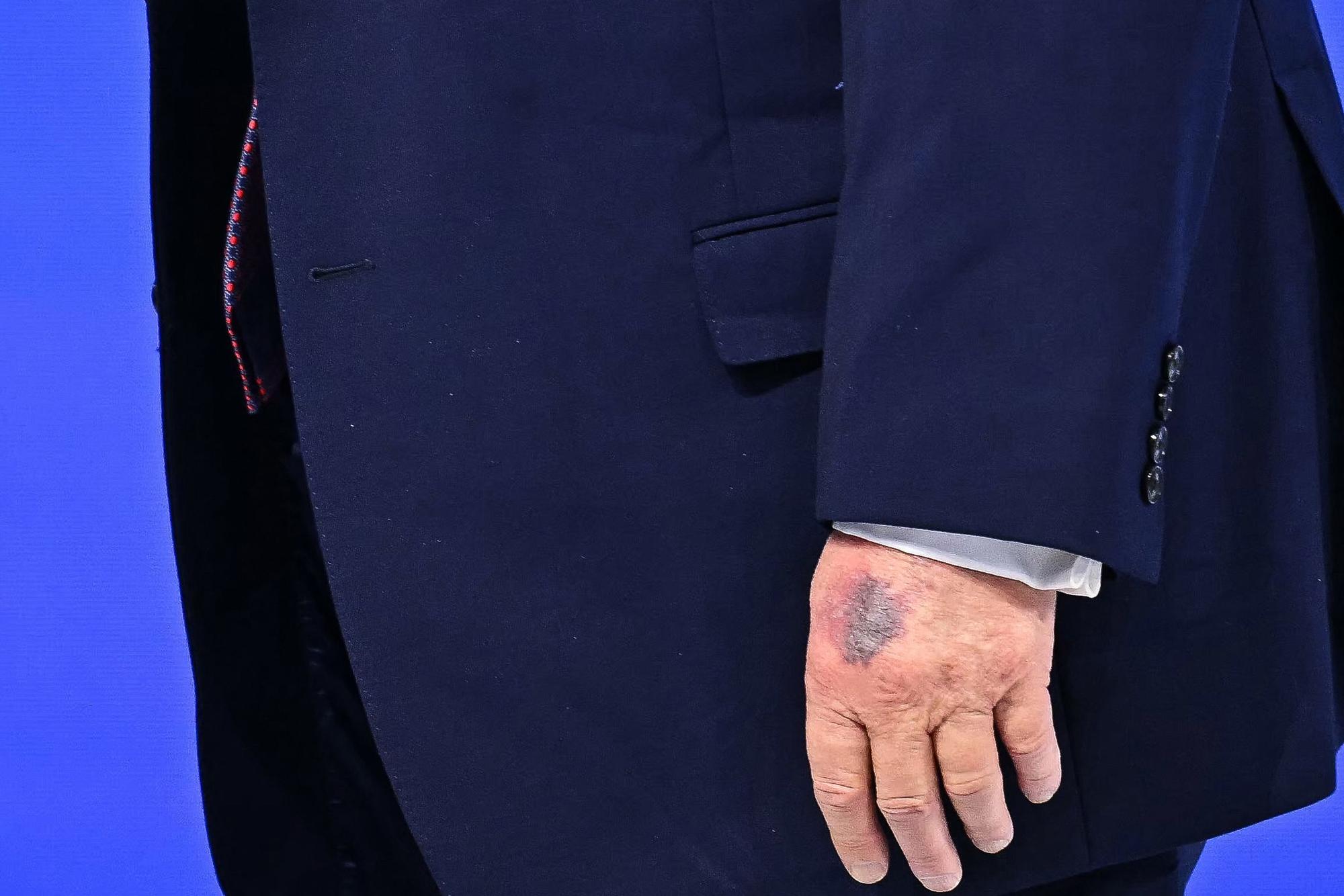 Auf der linken Hand von US-Präsident Donald Trump ist in Davos deutlich ein Bluterguss zu sehen.