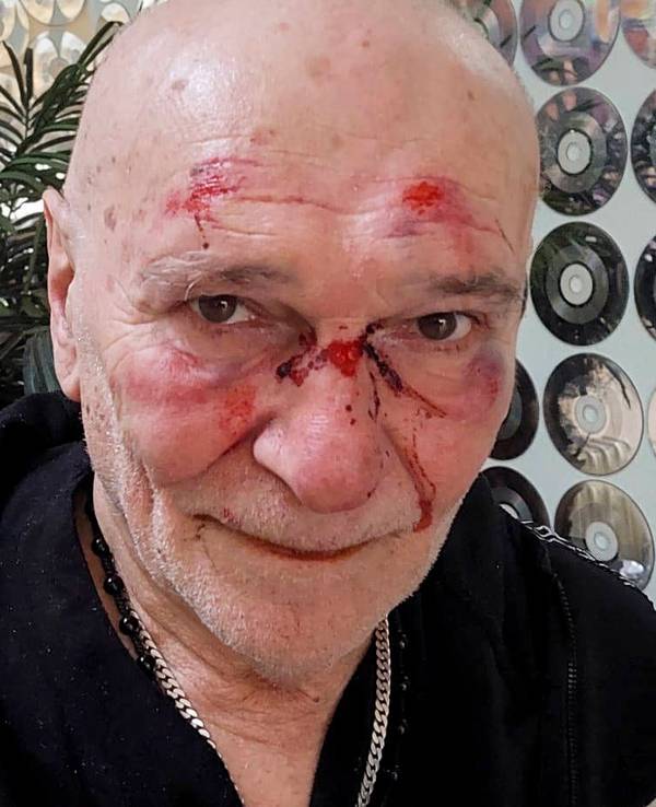 Der Schlagersänger Peter Sebastian veröffentlichte nach dem Überfall ein Foto, das die bei dem Angriff erlittenen Verletzungen in seinem Gesicht zeigt.