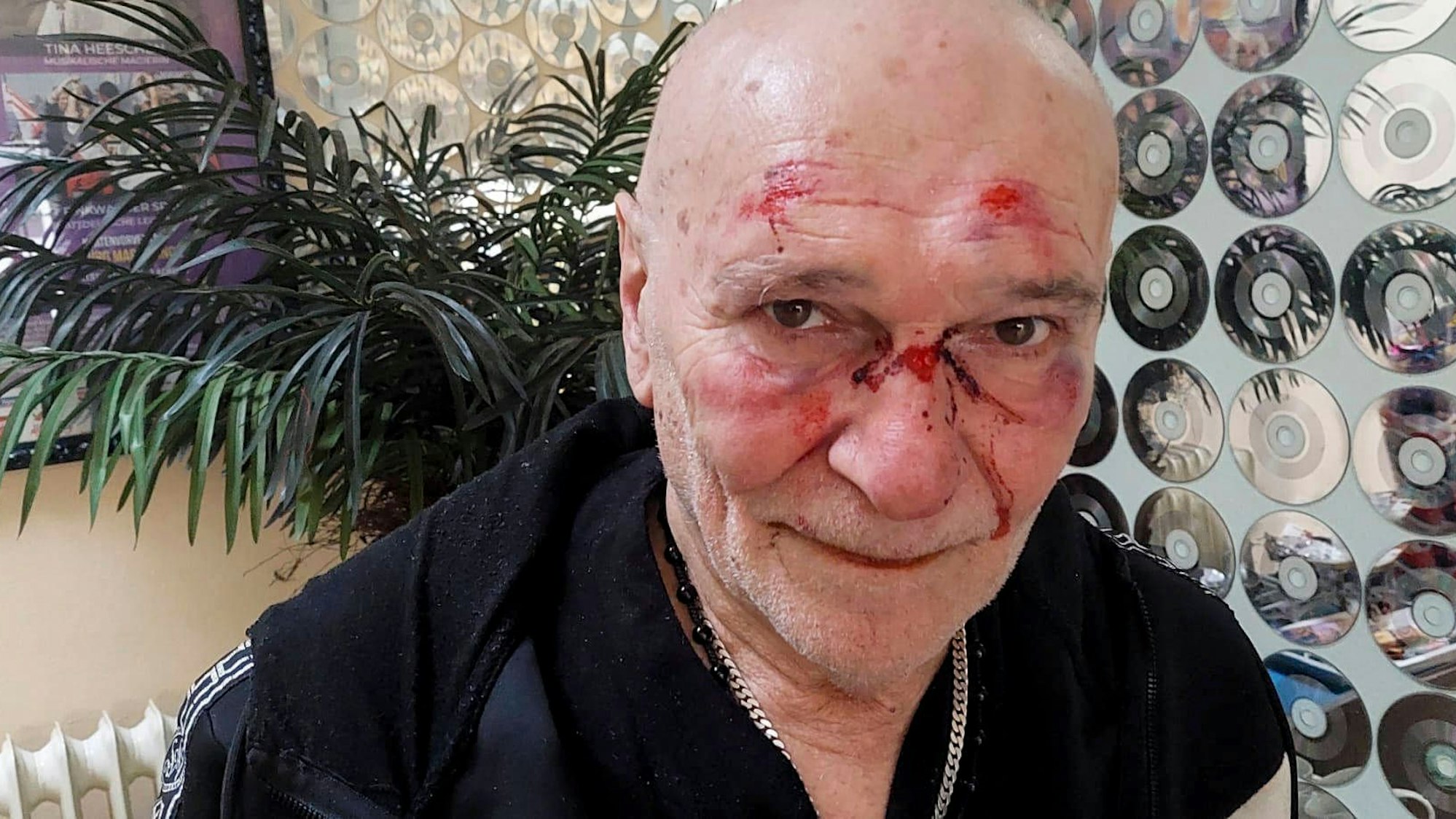 Der Schlagersänger Peter Sebastian veröffentlichte nach dem Überfall ein Foto, das die bei dem Angriff erlittenen Verletzungen in seinem Gesicht zeigt.