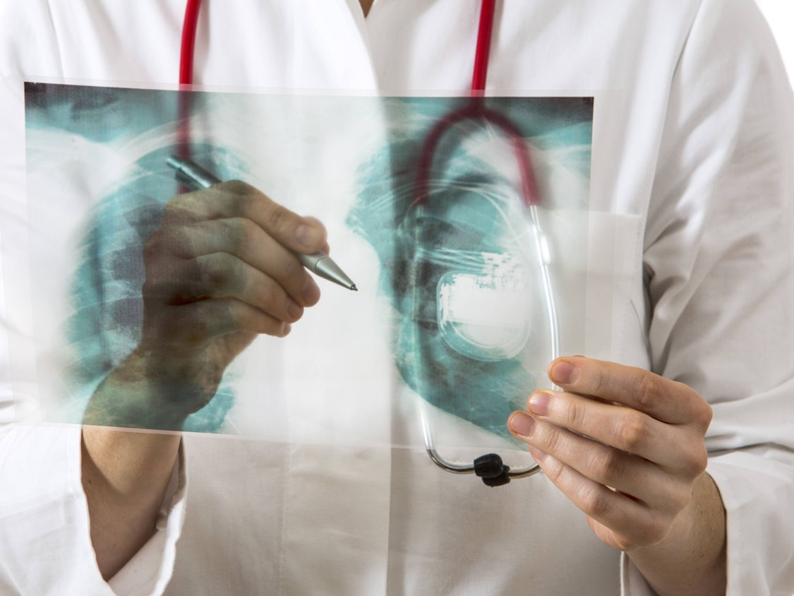Ärztin betrachtet Röntgenbild mit Herzschrittmacher
