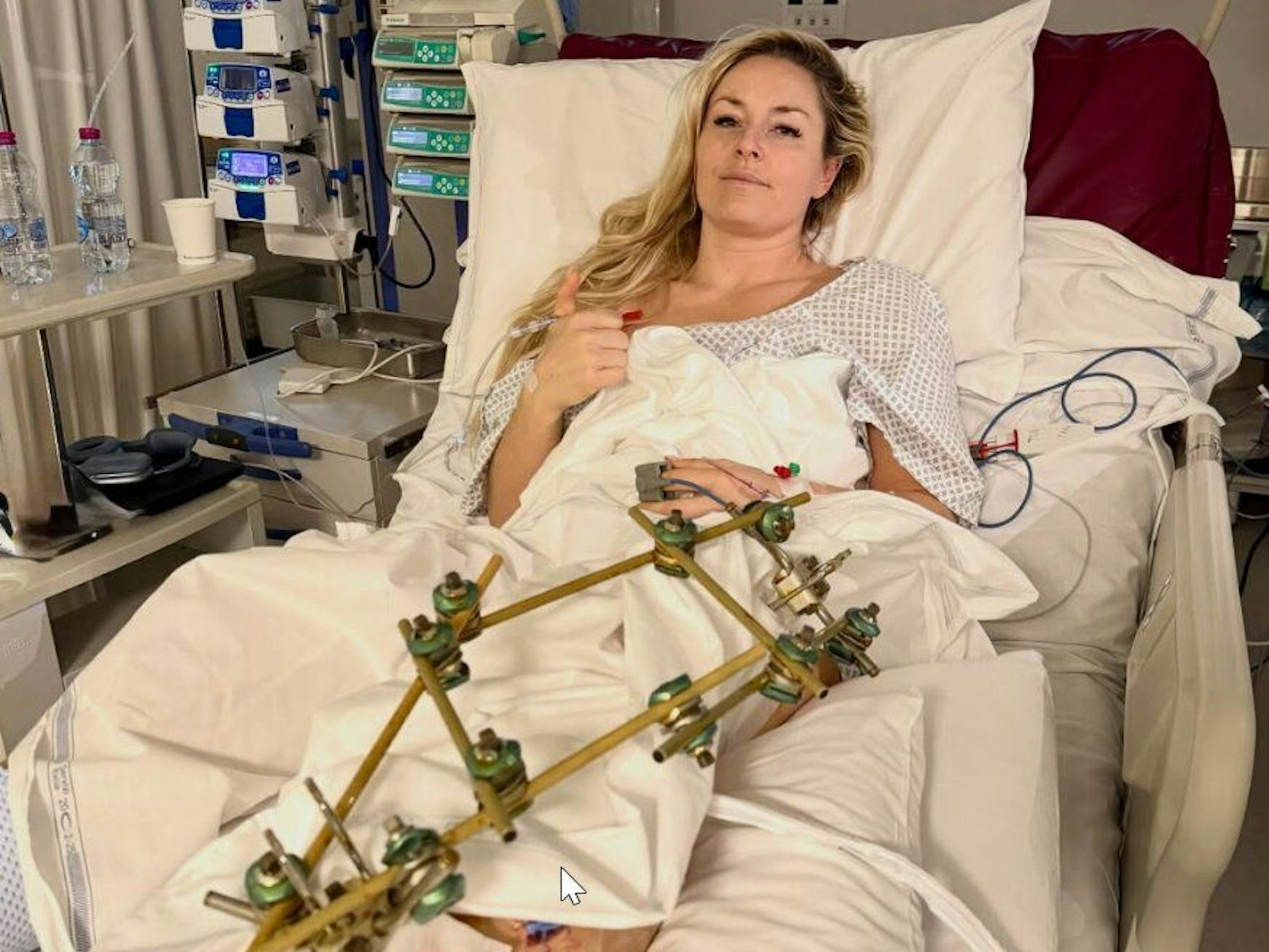 Lindsey Vonn im Krankenhausbett mit einem „Fixateur externe“ am verletzten Bein.