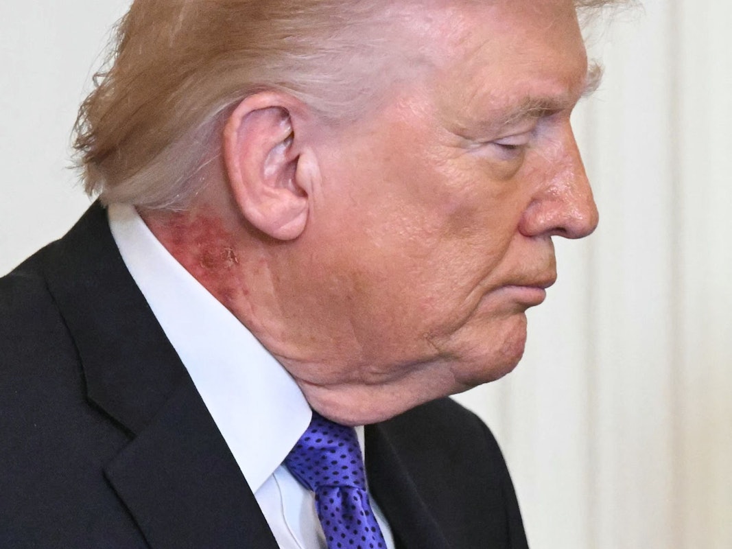 Donald Trump bei einer Verleihung der Ehrenmedaille im East Room des Weißen Hauses am 2. März 2026 in Washington, DC. Deutlich zu sehen: eine Hautveränderung am Hals des US-Präsidenten.
