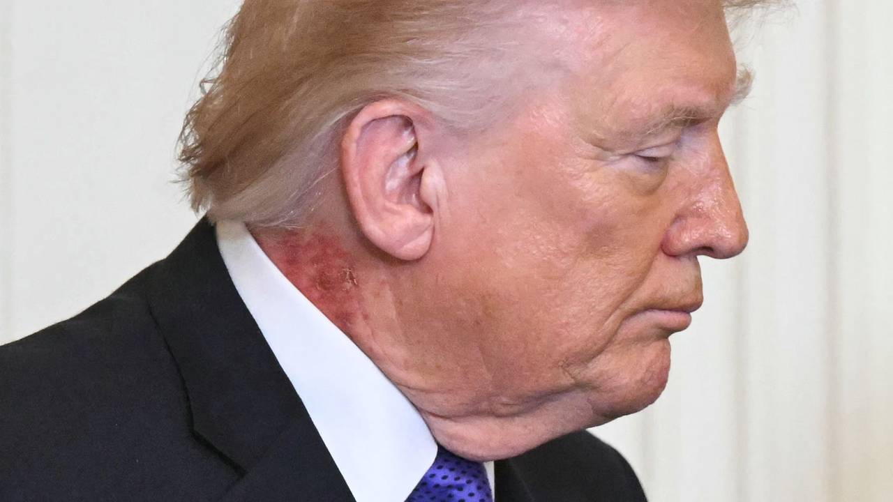 Donald Trump bei einer Verleihung der Ehrenmedaille im East Room des Weißen Hauses am 2. März 2026 in Washington, DC. Deutlich zu sehen: eine Hautveränderung am Hals des US-Präsidenten.