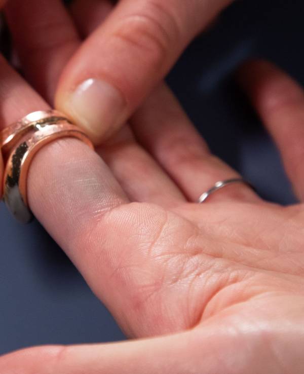 Verfärbungen durch Modeschmuck sind am Finger zu sehen
