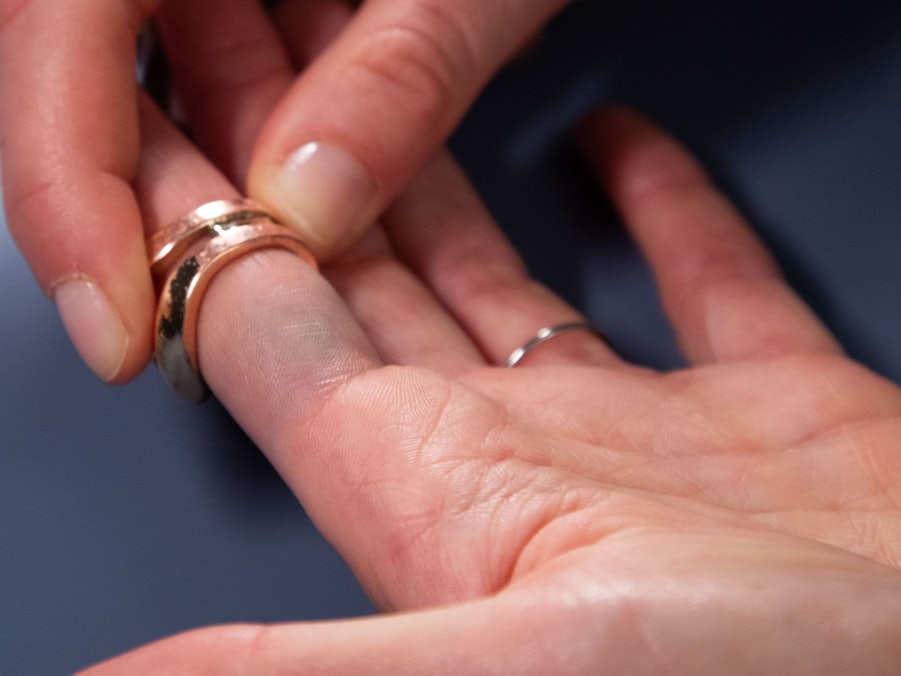 Verfärbungen durch Modeschmuck sind am Finger zu sehen