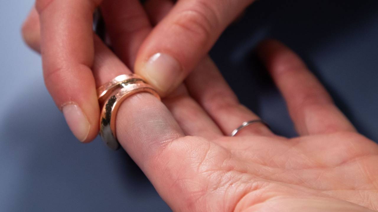 Verfärbungen durch Modeschmuck sind am Finger zu sehen