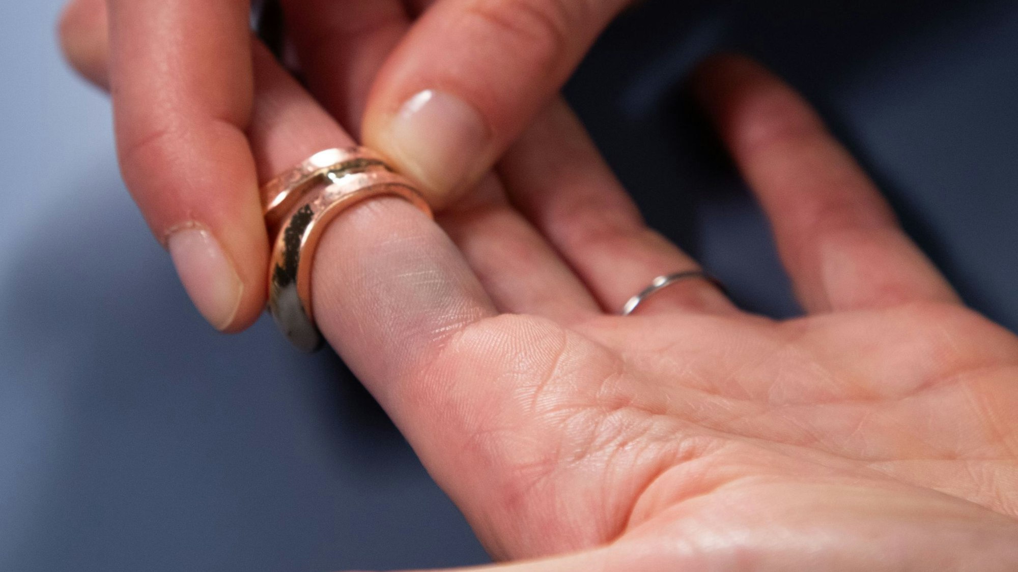 Verfärbungen durch Modeschmuck sind am Finger zu sehen