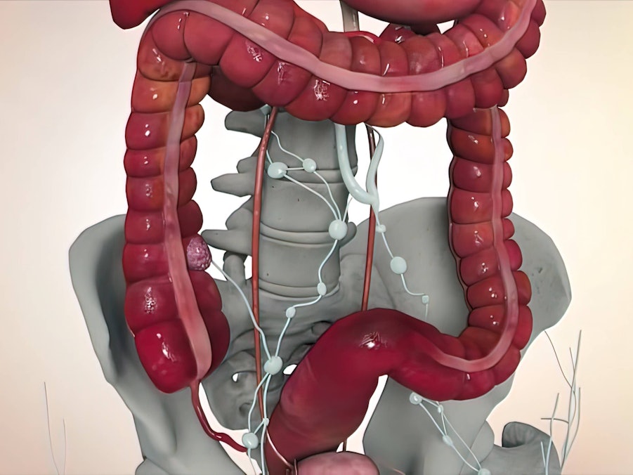 Darmkrebs-Tumor im menschlichen Verdauungssystem
