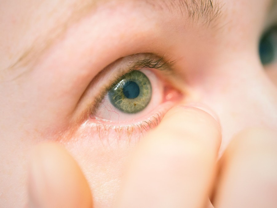 Eine Frau leidet unter einer Entzündung am Auge