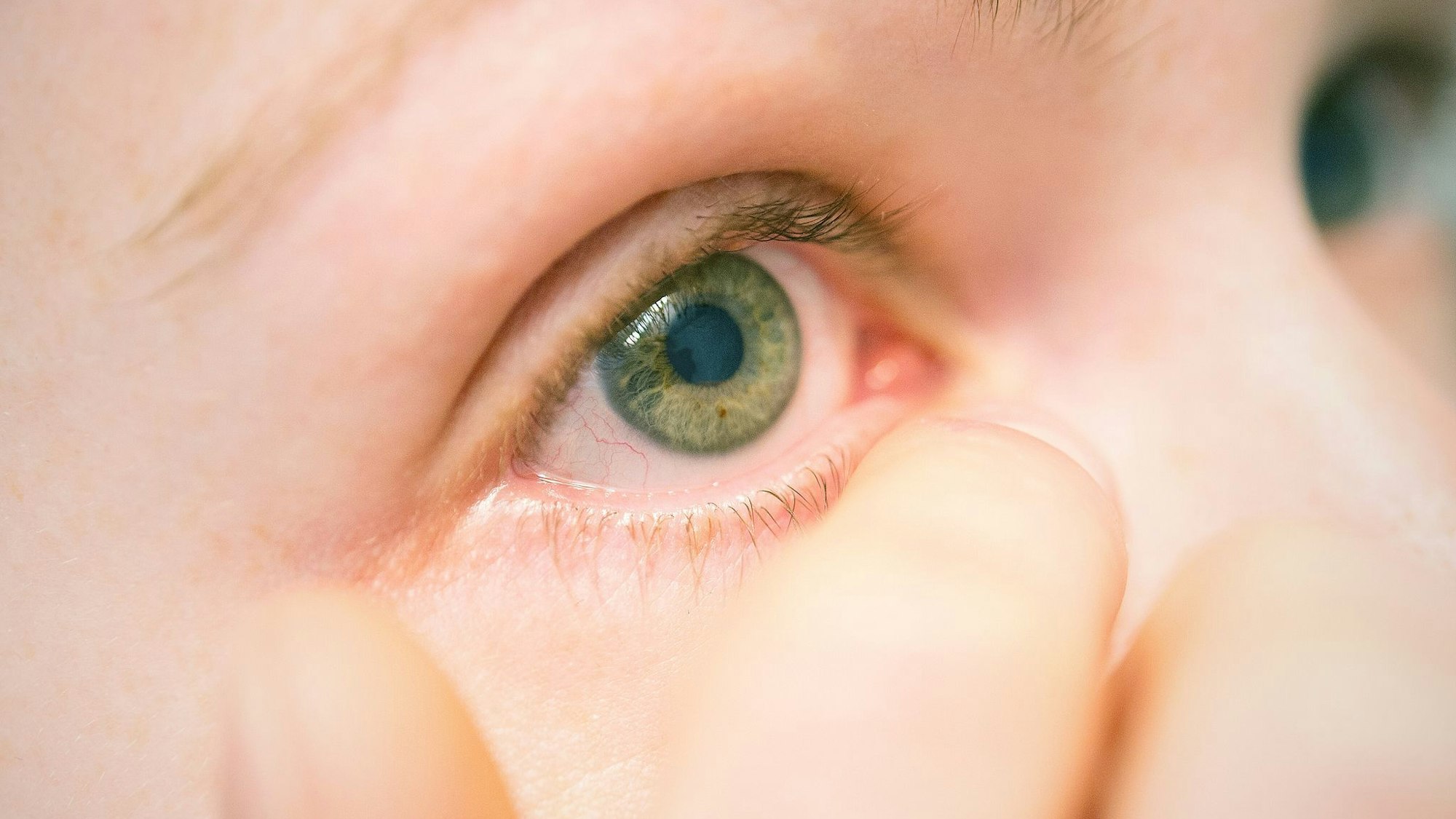 Eine Frau leidet unter einer Entzündung am Auge