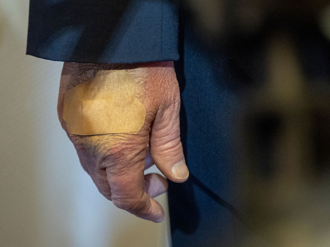 Die rechte Hand von US-Präsident Donald Trump ist bandagiert (Archivbild).