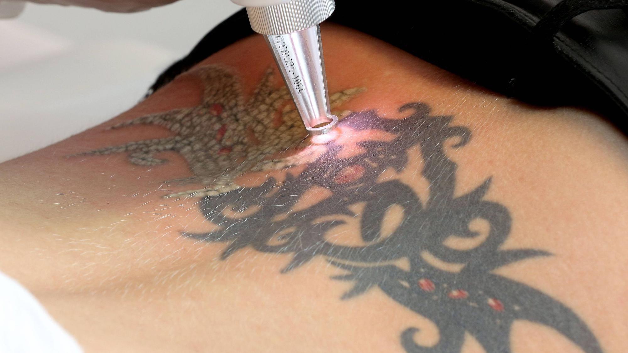 Tattoo-Entfernung per Laser