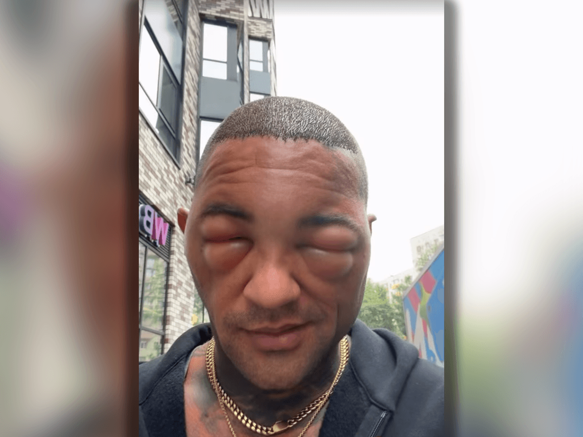 Influencer Max Jacobasch hatte nach einer Haartransplantation mit einem geschwollenen Gesicht zu kämpfen.