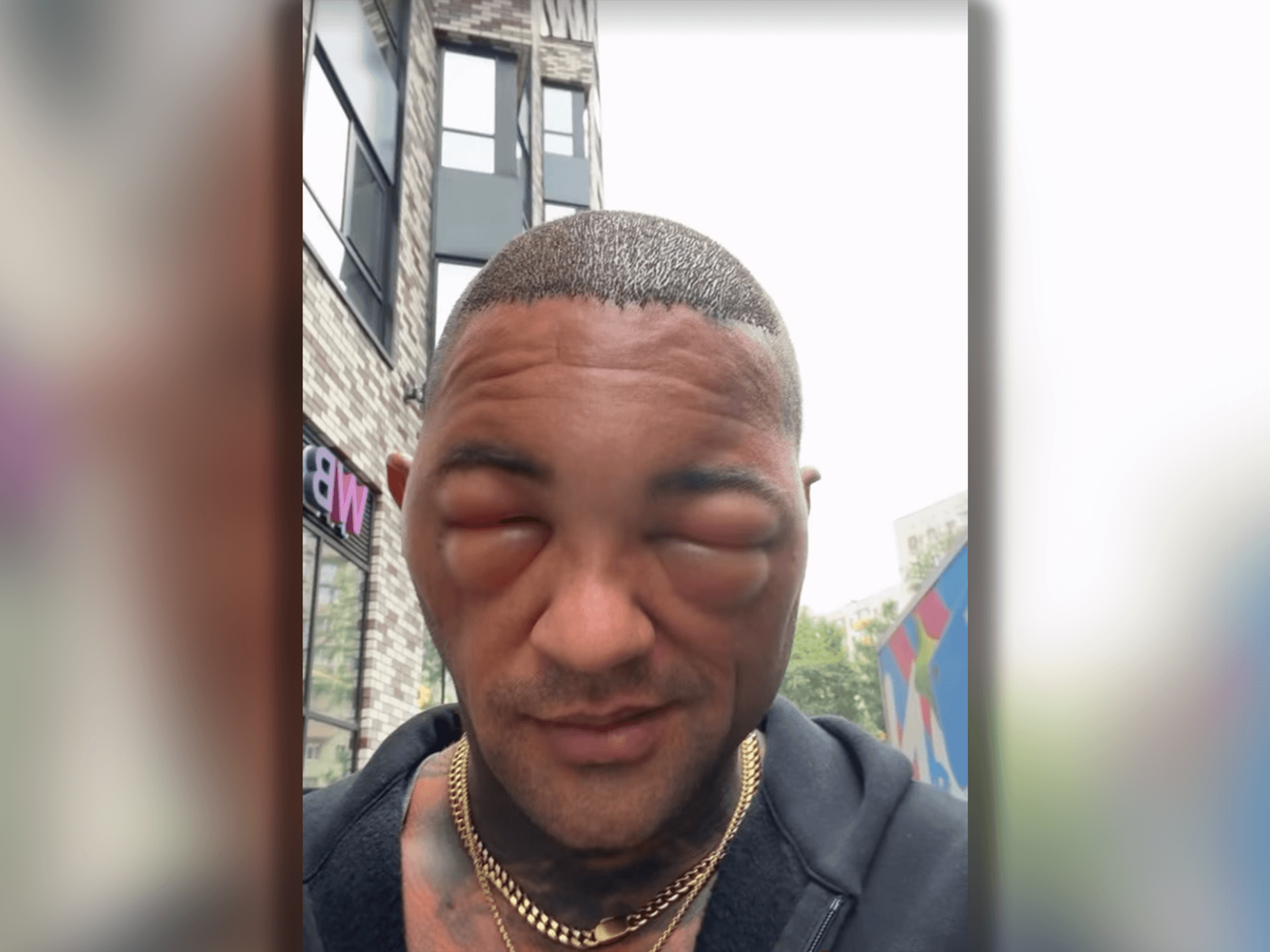 Influencer Max Jacobasch hatte nach einer Haartransplantation mit einem geschwollenen Gesicht zu kämpfen.