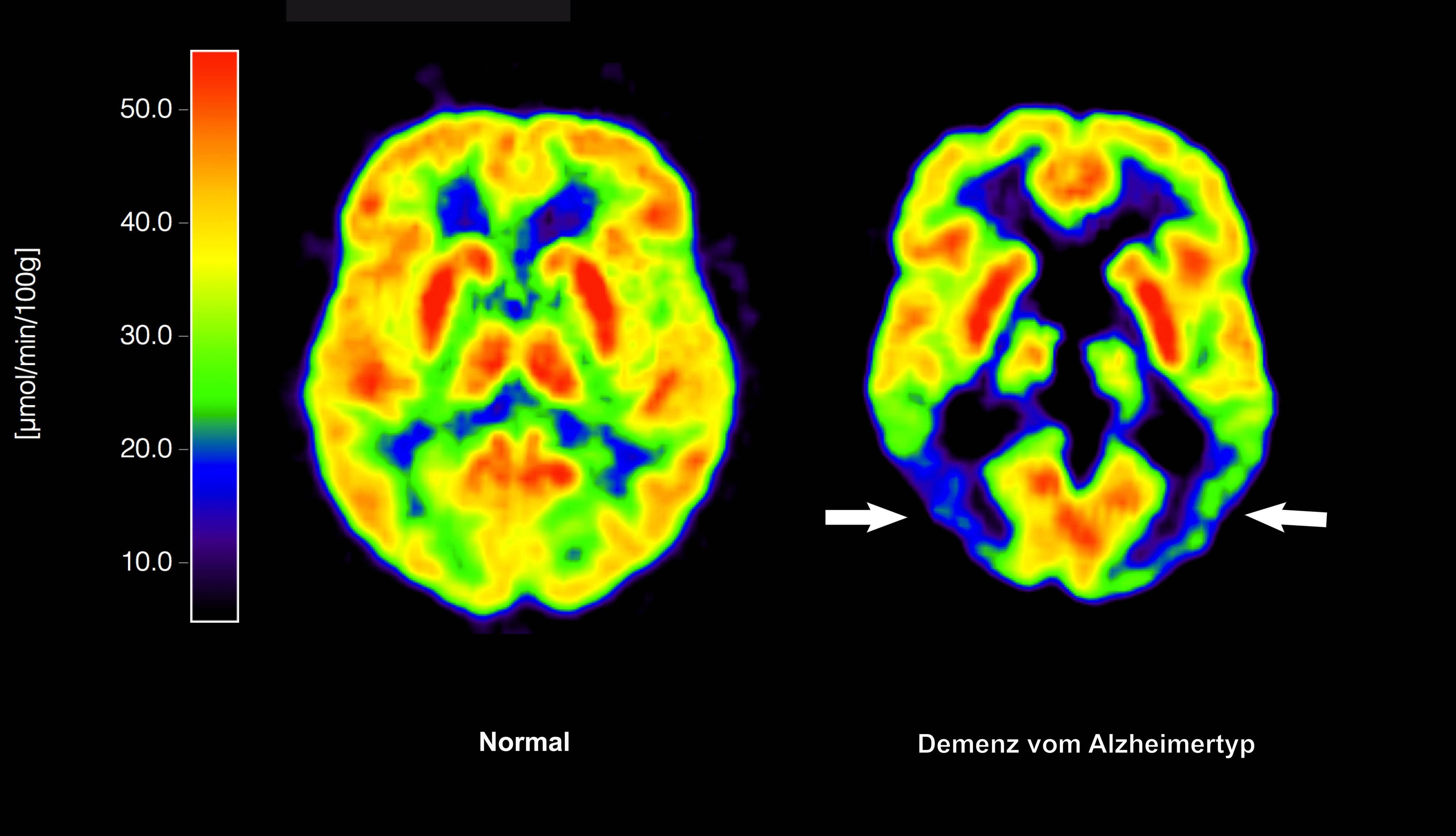 Positronen-Emissions- Tomografie (PET) erstellte Abbildung zeigt die Gegenüberstellung zweier Gehirne - im gesunden Zustand (l) und mit Alzheimer-Krankheit