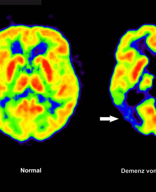 Positronen-Emissions- Tomografie (PET) erstellte Abbildung zeigt die Gegenüberstellung zweier Gehirne - im gesunden Zustand (l) und mit Alzheimer-Krankheit