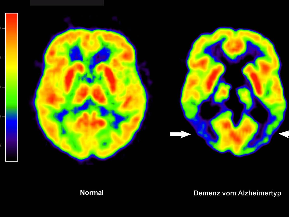 Positronen-Emissions- Tomografie (PET) erstellte Abbildung zeigt die Gegenüberstellung zweier Gehirne - im gesunden Zustand (l) und mit Alzheimer-Krankheit