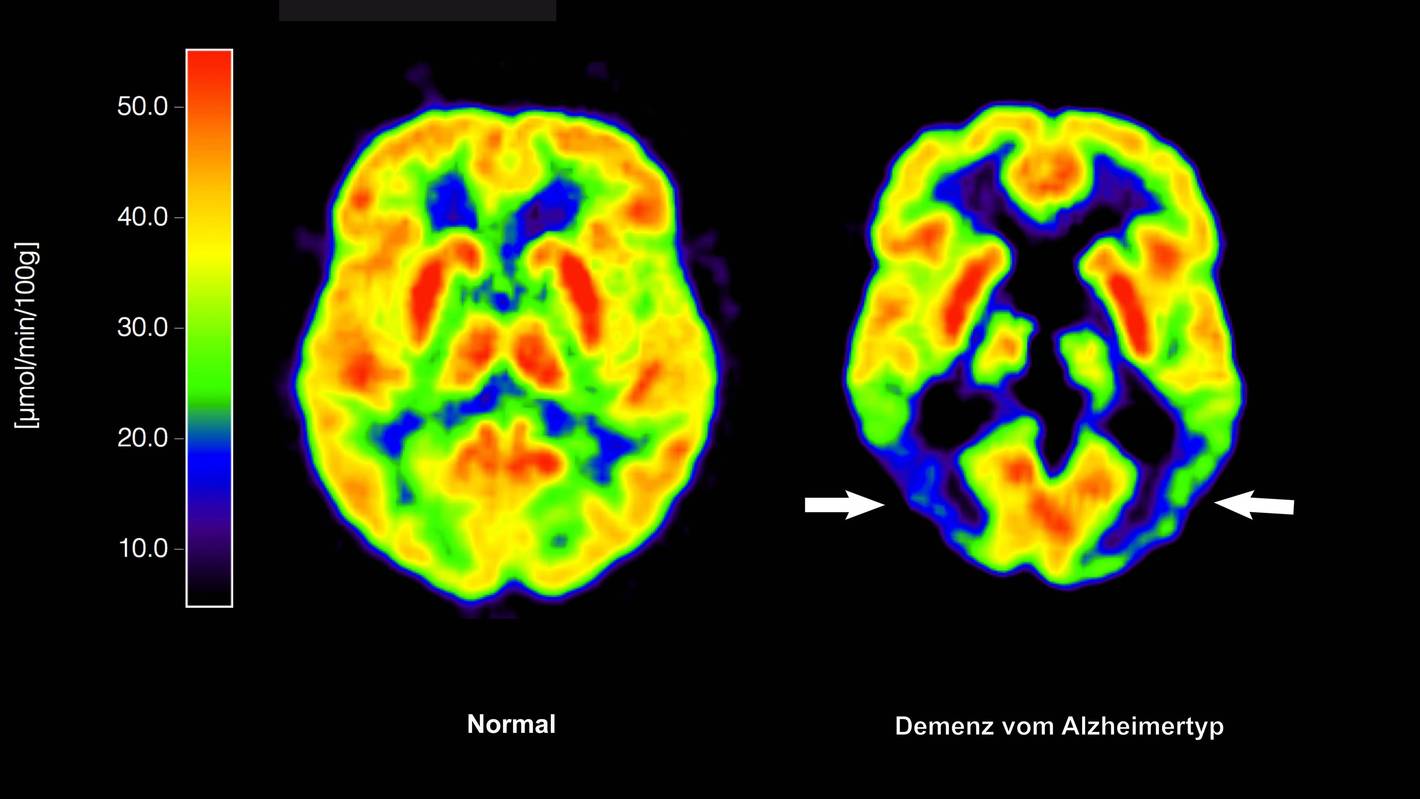 Positronen-Emissions- Tomografie (PET) erstellte Abbildung zeigt die Gegenüberstellung zweier Gehirne - im gesunden Zustand (l) und mit Alzheimer-Krankheit
