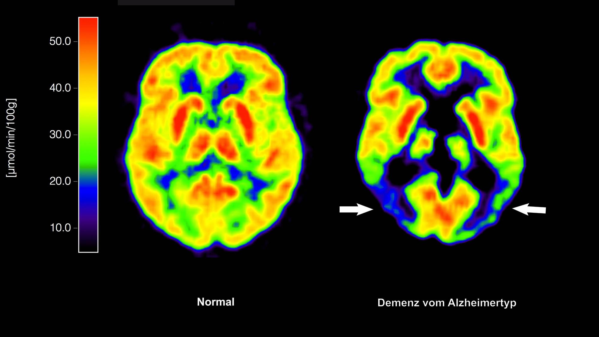 Positronen-Emissions- Tomografie (PET) erstellte Abbildung zeigt die Gegenüberstellung zweier Gehirne - im gesunden Zustand (l) und mit Alzheimer-Krankheit