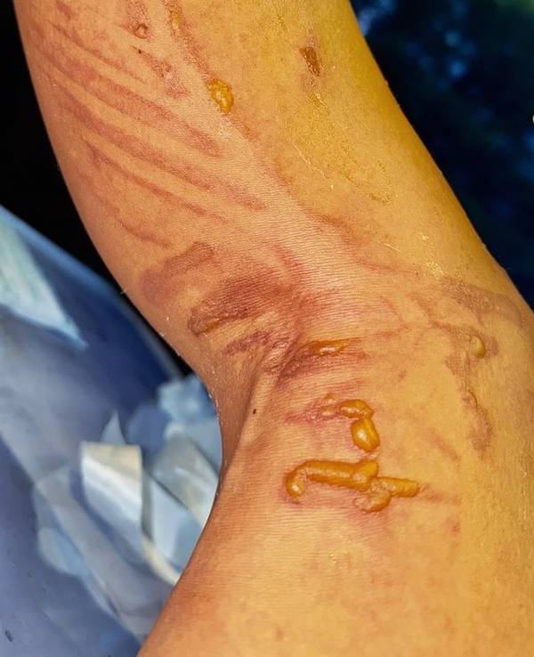 Nicole Scherzinger, hat sich vor ihrem Konzert in Düsseldorf schwere Verbrühungen zugezogen. Auf ihrem Instagram-Account postete sie ihre Verletzung.
