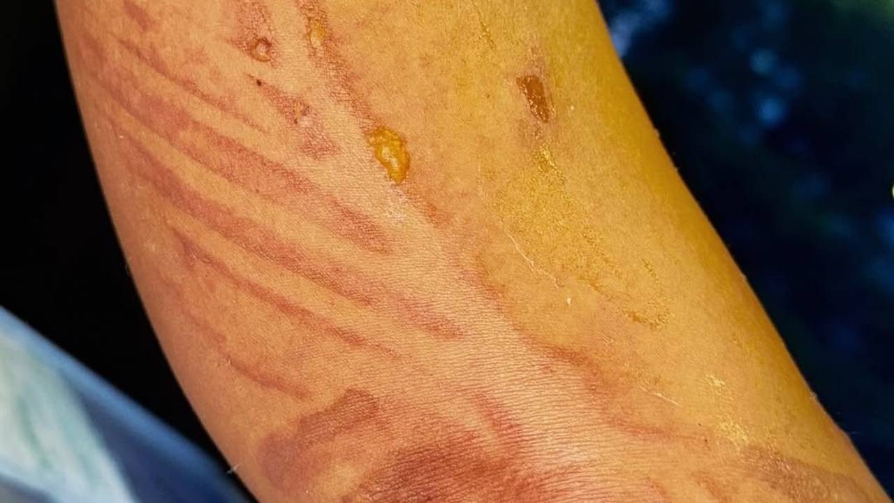 Nicole Scherzinger, hat sich vor ihrem Konzert in Düsseldorf schwere Verbrühungen zugezogen. Auf ihrem Instagram-Account postete sie ihre Verletzung.