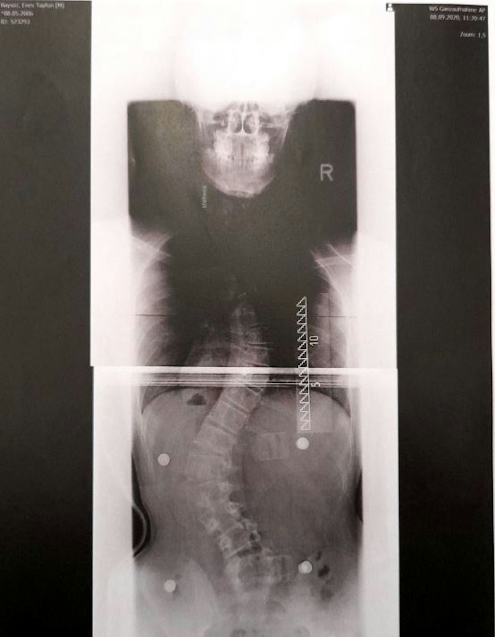 enes_baysöz_skoliose_03_12_2020_02