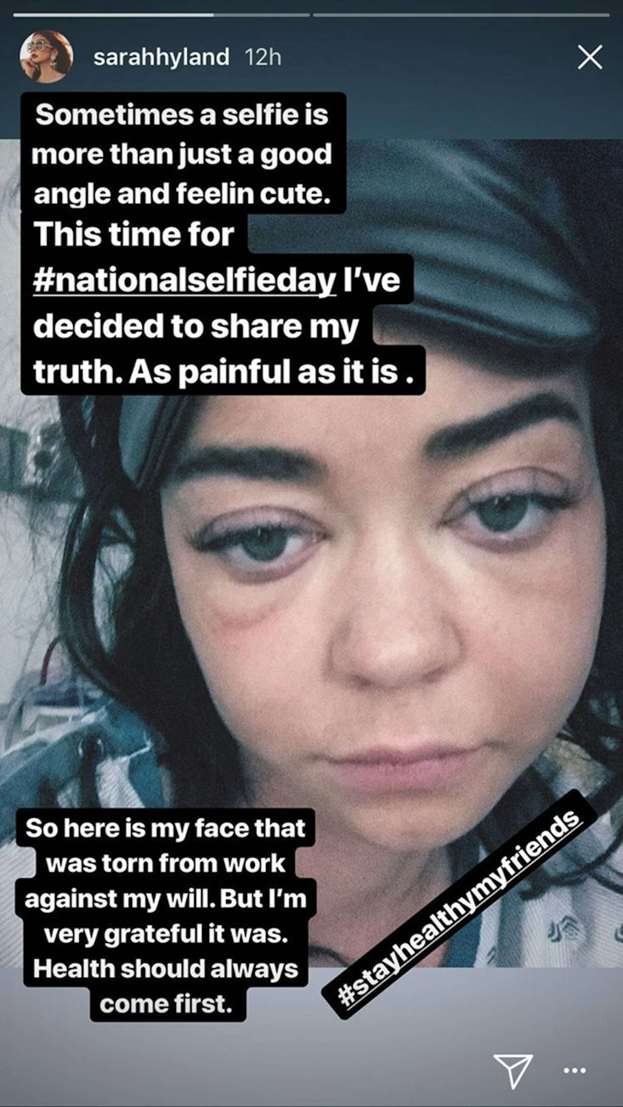 Sarah_Hyland_geschwollen