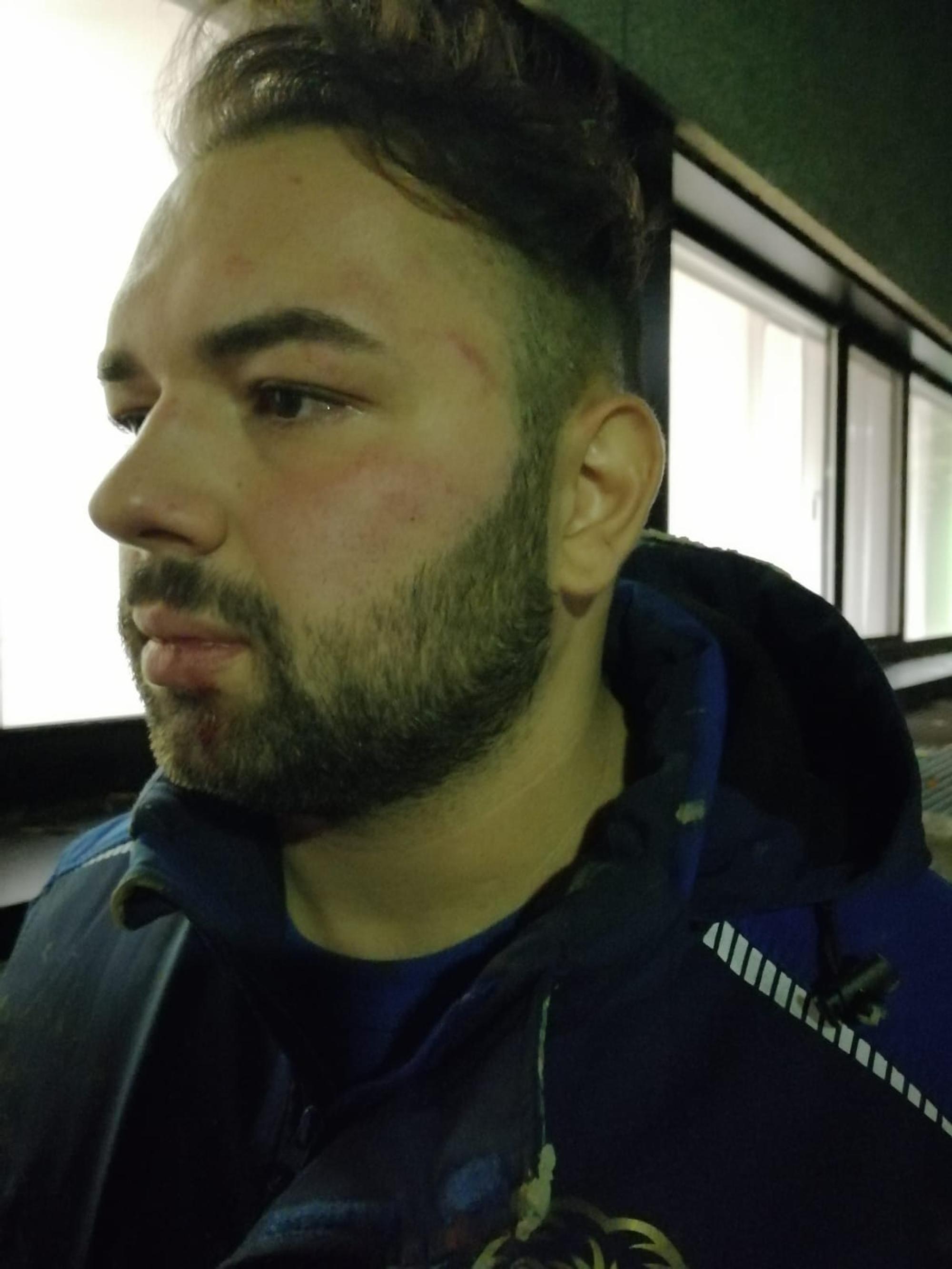 Der Kölner Yüksel Aker hatte nach dem Polizeieinsatz mehrere Blessuren im Gesicht.