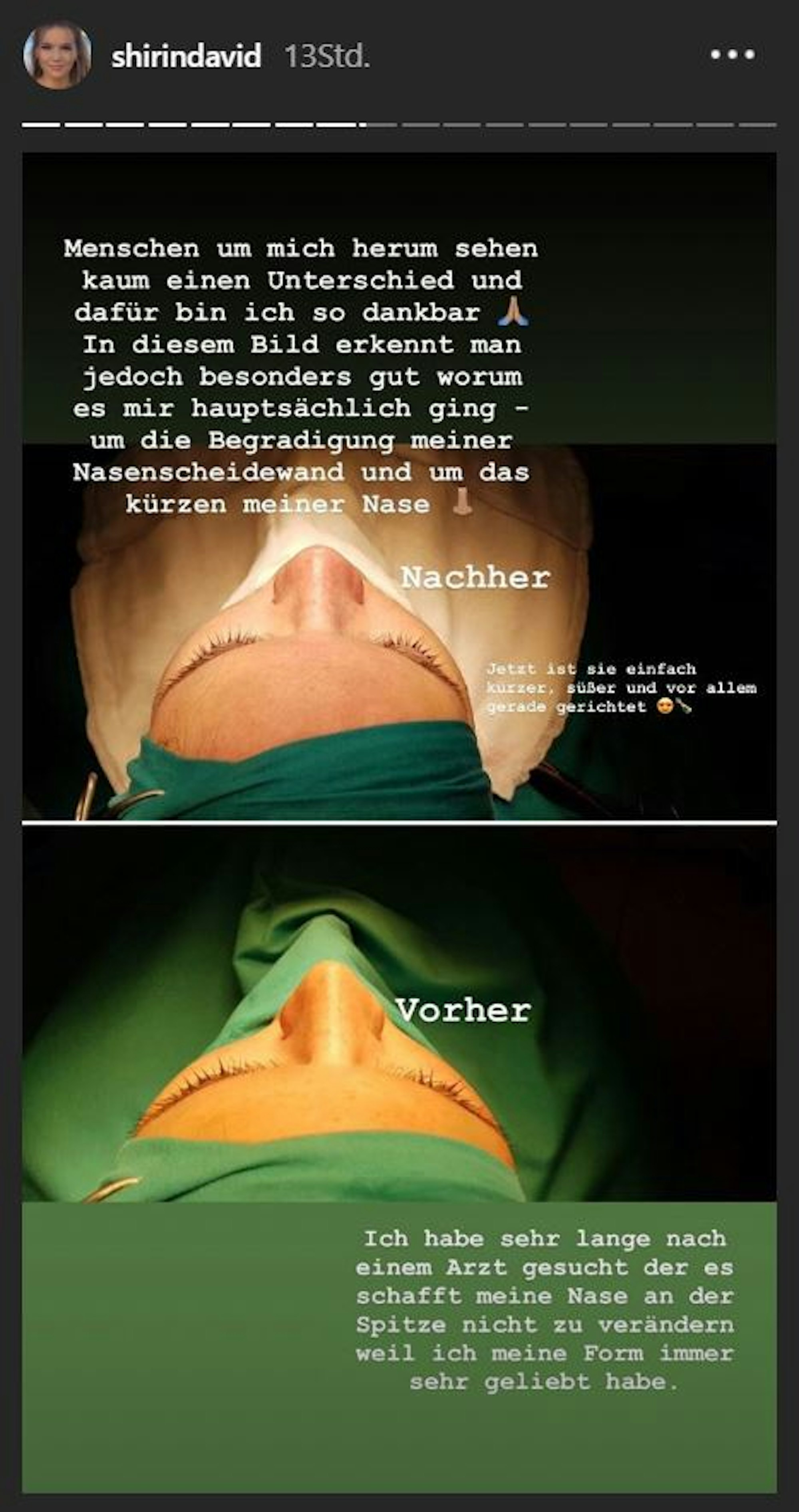 Shirin_David_Nase_OP_story2