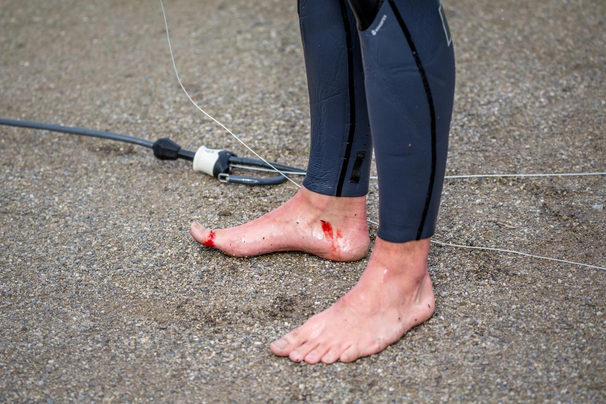 Blutige Füße Kitesurfer Aachener Weiher