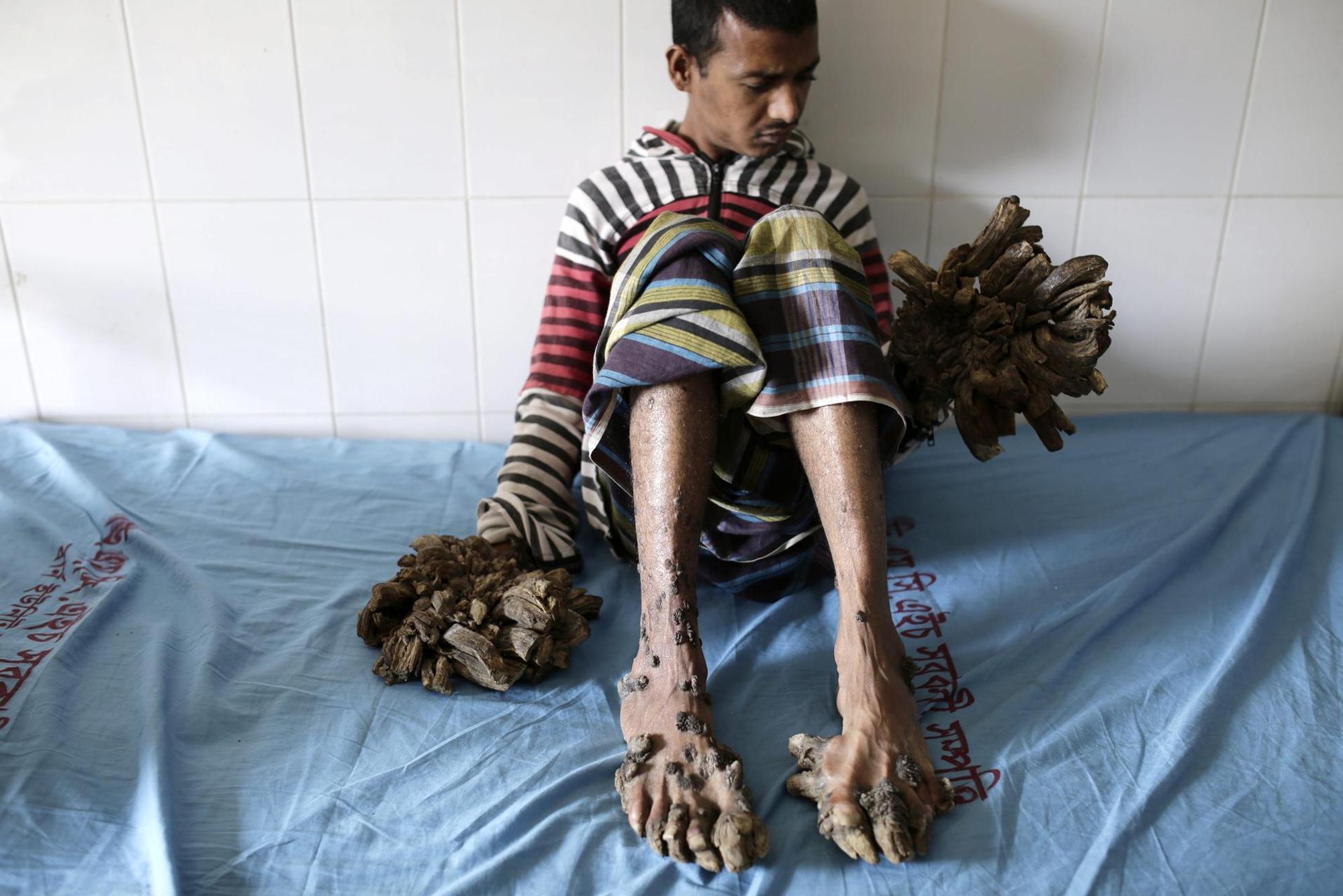 Abul Bajandar_Tree_Man_Baummensch_alt_ganz (1)