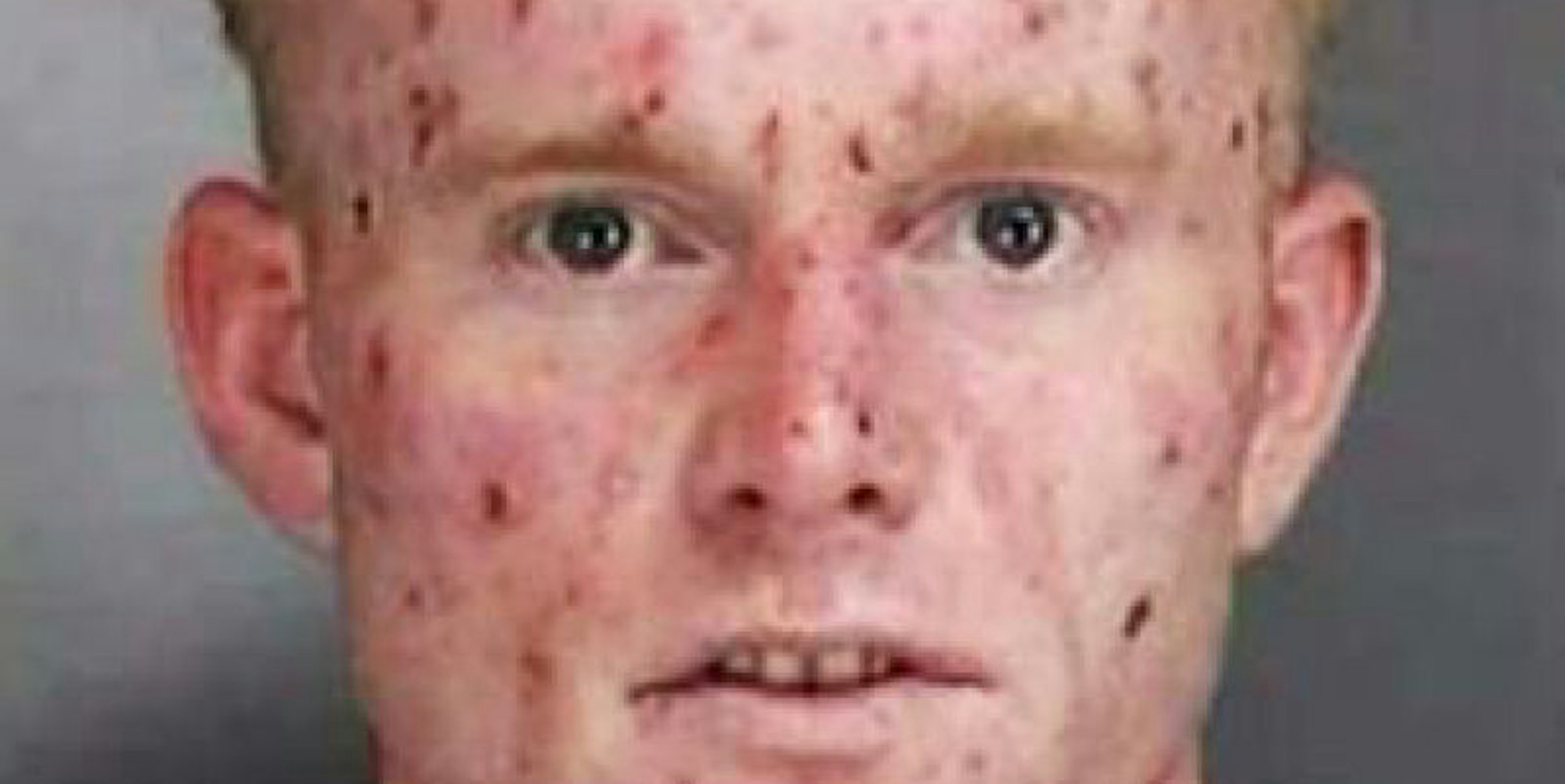 David Charles entstelltes Gesicht