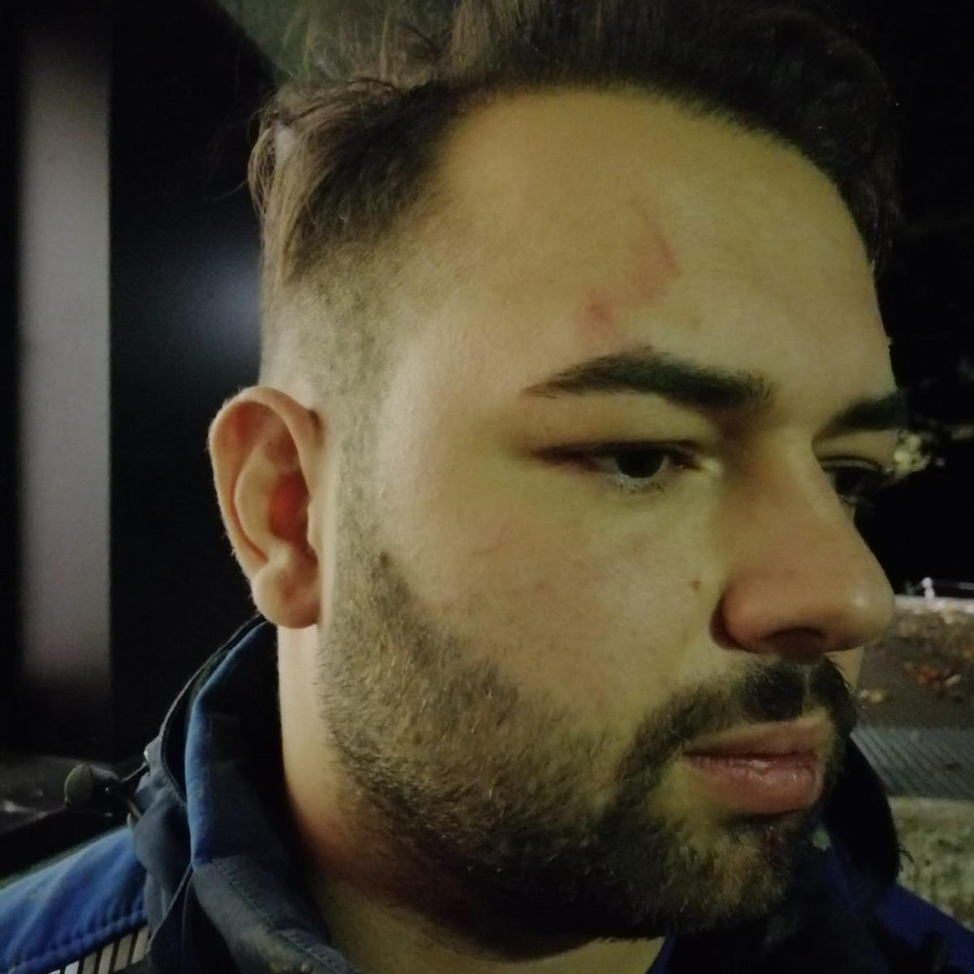 Yüksel Aker zeigt seine Verletzungen nach einem Polizeieinsatz.