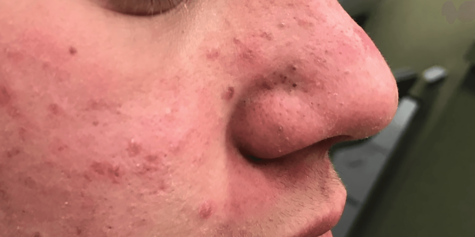 pimple