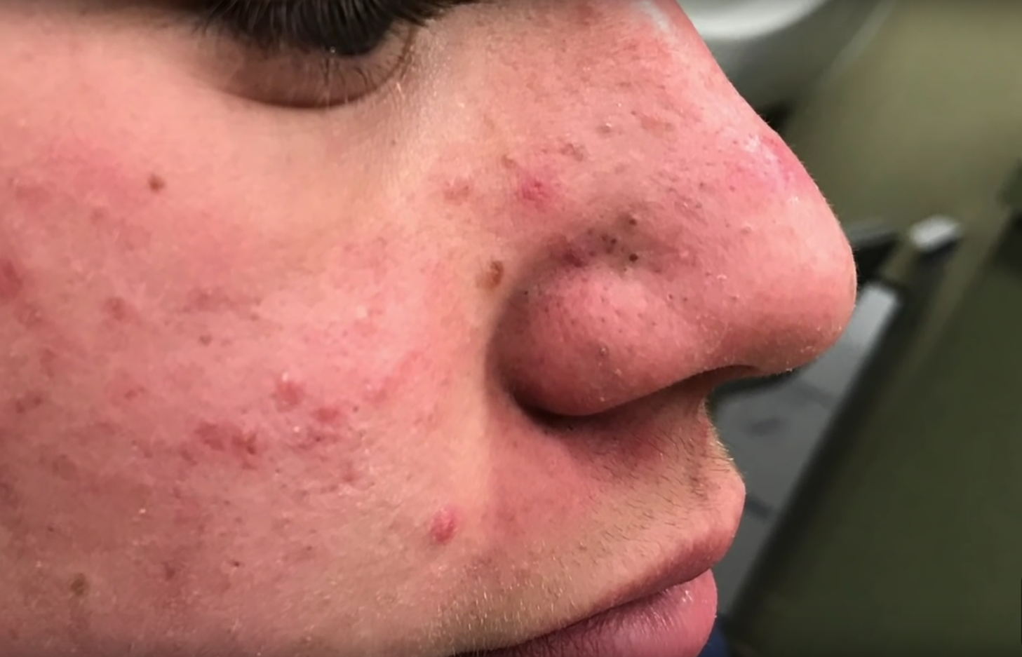 Dr. Pimple Popper: Youtbube-Kanal sorgt fr Ekel und Unverstndnis | Express Dr. Pimple Popper: Youtbube-Kanal sorgt fr Ekel und Unverstndnis | Express