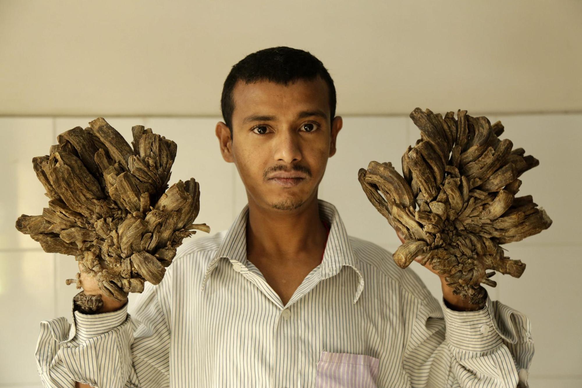 Abul Bajandar_Tree_Man_Baummensch_alt_Hände (1)